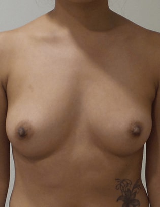 Breast Augmentation Silicone Implants Before and After | CIARAVINO Plastic Surgery