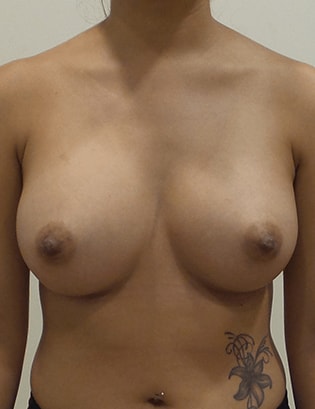 Breast Augmentation Silicone Implants Before and After | CIARAVINO Plastic Surgery