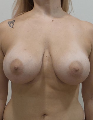 Breast Augmentation Silicone Implants Before and After | CIARAVINO Plastic Surgery