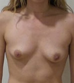 Breast Augmentation Silicone Implants Before and After | CIARAVINO Plastic Surgery