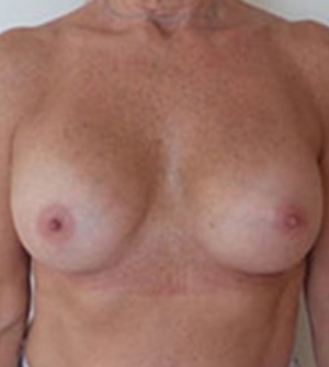 Breast Augmentation Silicone Implants Before and After | CIARAVINO Plastic Surgery