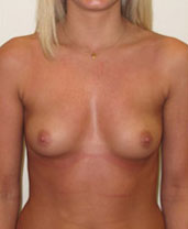 Breast Augmentation Silicone Implants Before and After | CIARAVINO Plastic Surgery