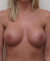 Breast Augmentation Silicone Implants Before and After | CIARAVINO Plastic Surgery