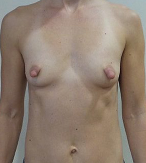 Breast Augmentation Silicone Implants Before and After | CIARAVINO Plastic Surgery