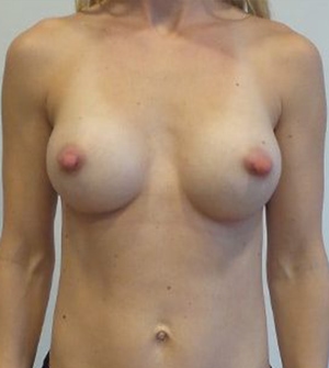 Breast Augmentation Silicone Implants Before and After | CIARAVINO Plastic Surgery