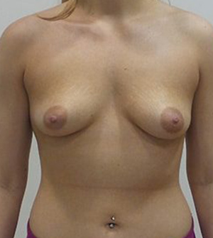 Breast Augmentation Silicone Implants Before and After | CIARAVINO Plastic Surgery