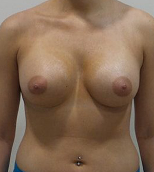 Breast Augmentation Silicone Implants Before and After | CIARAVINO Plastic Surgery