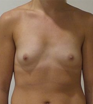 Breast Augmentation Silicone Implants Before and After | CIARAVINO Plastic Surgery