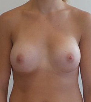 Breast Augmentation Silicone Implants Before and After | CIARAVINO Plastic Surgery