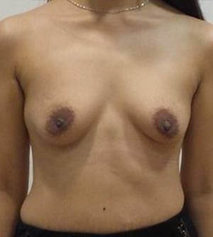 Breast Augmentation Silicone Implants Before and After | CIARAVINO Plastic Surgery