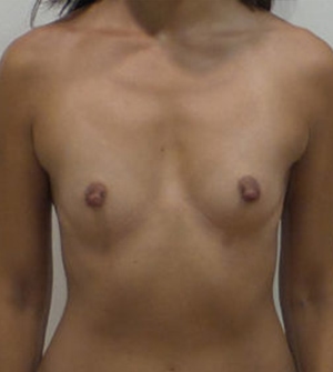 Breast Augmentation Silicone Implants Before and After | CIARAVINO Plastic Surgery