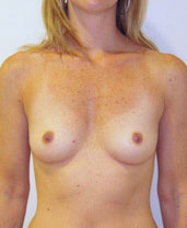 Breast Augmentation Silicone Implants Before and After | CIARAVINO Plastic Surgery