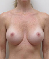 Breast Augmentation Silicone Implants Before and After | CIARAVINO Plastic Surgery