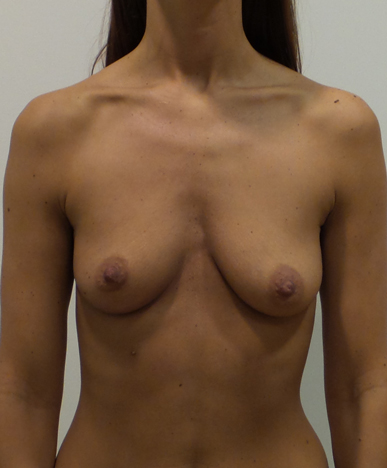 Breast Augmentation Silicone Implants Before and After | CIARAVINO Plastic Surgery