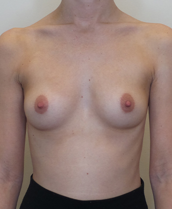 Breast Augmentation Silicone Implants Before and After | CIARAVINO Plastic Surgery