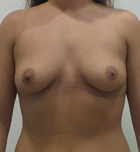 Breast Augmentation Silicone Implants Before and After | CIARAVINO Plastic Surgery