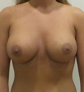 Breast Augmentation Silicone Implants Before and After | CIARAVINO Plastic Surgery