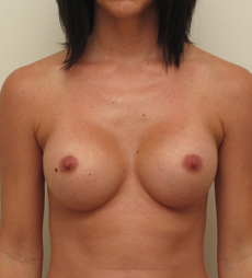 Breast Augmentation Silicone Implants Before and After | CIARAVINO Plastic Surgery