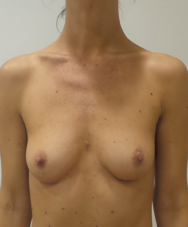 Breast Augmentation Silicone Implants Before and After | CIARAVINO Plastic Surgery