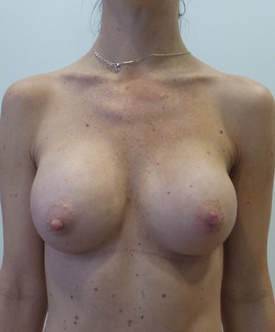 Breast Augmentation Silicone Implants Before and After | CIARAVINO Plastic Surgery