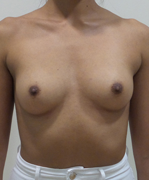 Breast Augmentation Silicone Implants Before and After | CIARAVINO Plastic Surgery