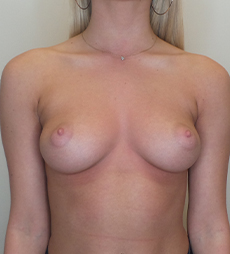 Breast Augmentation Silicone Implants Before and After | CIARAVINO Plastic Surgery