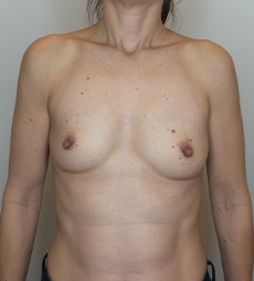 Breast Augmentation Silicone Implants Before and After | CIARAVINO Plastic Surgery