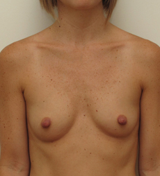 Breast Augmentation Silicone Implants Before and After | CIARAVINO Plastic Surgery