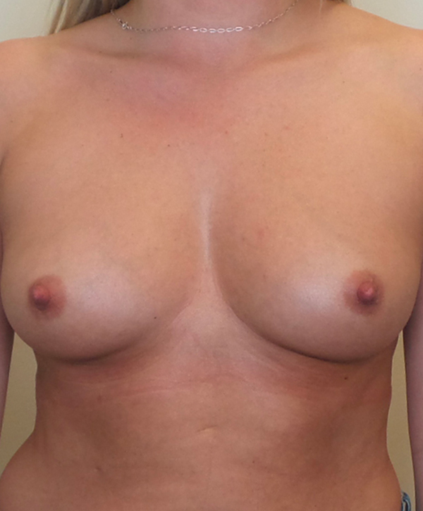 Breast Augmentation Silicone Implants Before and After | CIARAVINO Plastic Surgery