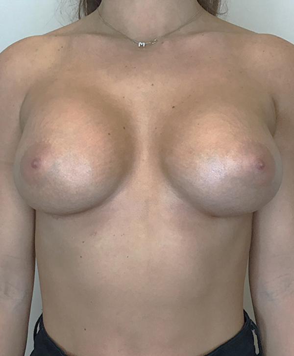 Breast Augmentation Silicone Implants Before and After | CIARAVINO Plastic Surgery