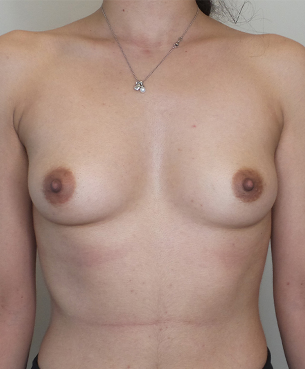 Breast Augmentation Silicone Implants Before and After | CIARAVINO Plastic Surgery