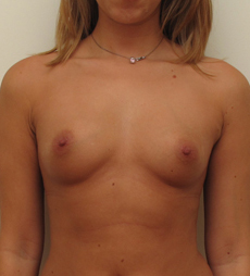 Breast Augmentation Silicone Implants Before and After | CIARAVINO Plastic Surgery