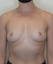 Breast Augmentation Silicone Implants Before and After | CIARAVINO Plastic Surgery