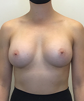 Breast Augmentation Silicone Implants Before and After | CIARAVINO Plastic Surgery