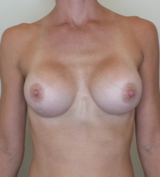 Breast Augmentation Silicone Implants Before and After | CIARAVINO Plastic Surgery