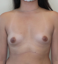 Breast Augmentation Silicone Implants Before and After | CIARAVINO Plastic Surgery