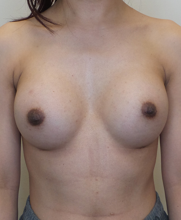 Breast Augmentation Silicone Implants Before and After | CIARAVINO Plastic Surgery