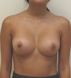 Breast Augmentation Silicone Implants Before and After | CIARAVINO Plastic Surgery