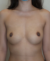 Breast Augmentation Silicone Implants Before and After | CIARAVINO Plastic Surgery