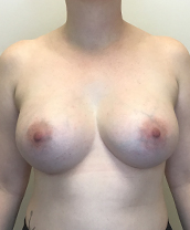 Breast Augmentation Silicone Implants Before and After | CIARAVINO Plastic Surgery