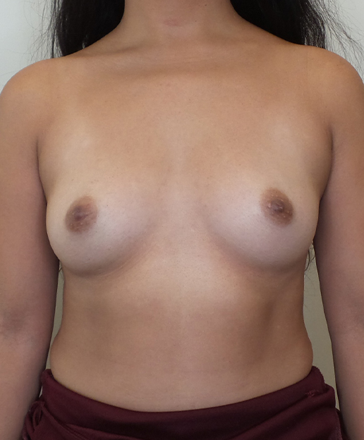 Breast Augmentation Silicone Implants Before and After | CIARAVINO Plastic Surgery