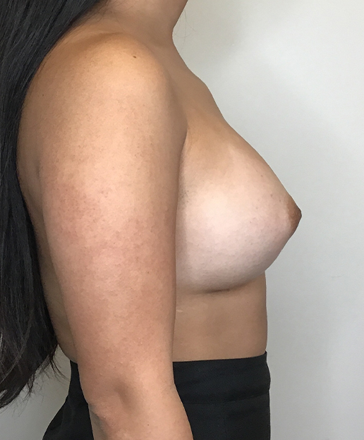 Breast Augmentation Silicone Implants Before and After | CIARAVINO Plastic Surgery