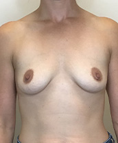 Breast Augmentation Silicone Implants Before and After | CIARAVINO Plastic Surgery