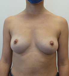 Breast Augmentation Silicone Implants Before and After | CIARAVINO Plastic Surgery