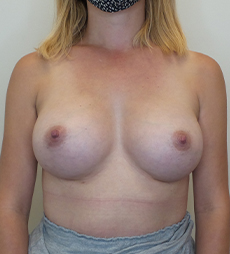 Breast Augmentation Silicone Implants Before and After | CIARAVINO Plastic Surgery