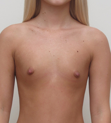 Breast Augmentation Silicone Implants Before and After | CIARAVINO Plastic Surgery