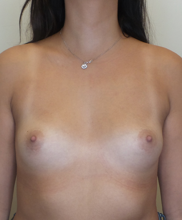 Breast Augmentation Silicone Implants Before and After | CIARAVINO Plastic Surgery