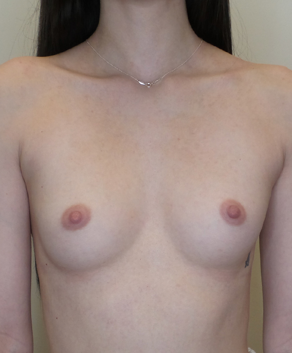 Breast Augmentation Silicone Implants Before and After | CIARAVINO Plastic Surgery