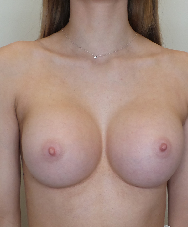 Breast Augmentation Silicone Implants Before and After | CIARAVINO Plastic Surgery