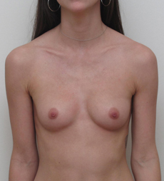 Breast Augmentation Silicone Implants Before and After | CIARAVINO Plastic Surgery